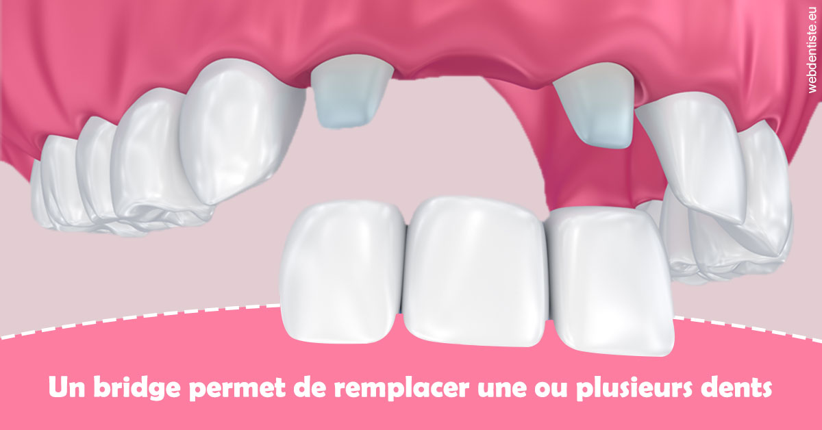 https://dr-andre-boquet-corinne-marie.chirurgiens-dentistes.fr/Bridge remplacer dents 2