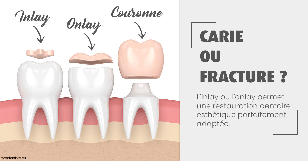 https://dr-andre-boquet-corinne-marie.chirurgiens-dentistes.fr/T2 2023 - Carie ou fracture 1