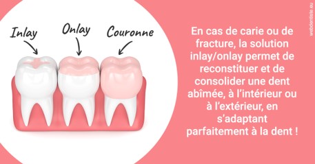 https://dr-andre-boquet-corinne-marie.chirurgiens-dentistes.fr/L'INLAY ou l'ONLAY 2