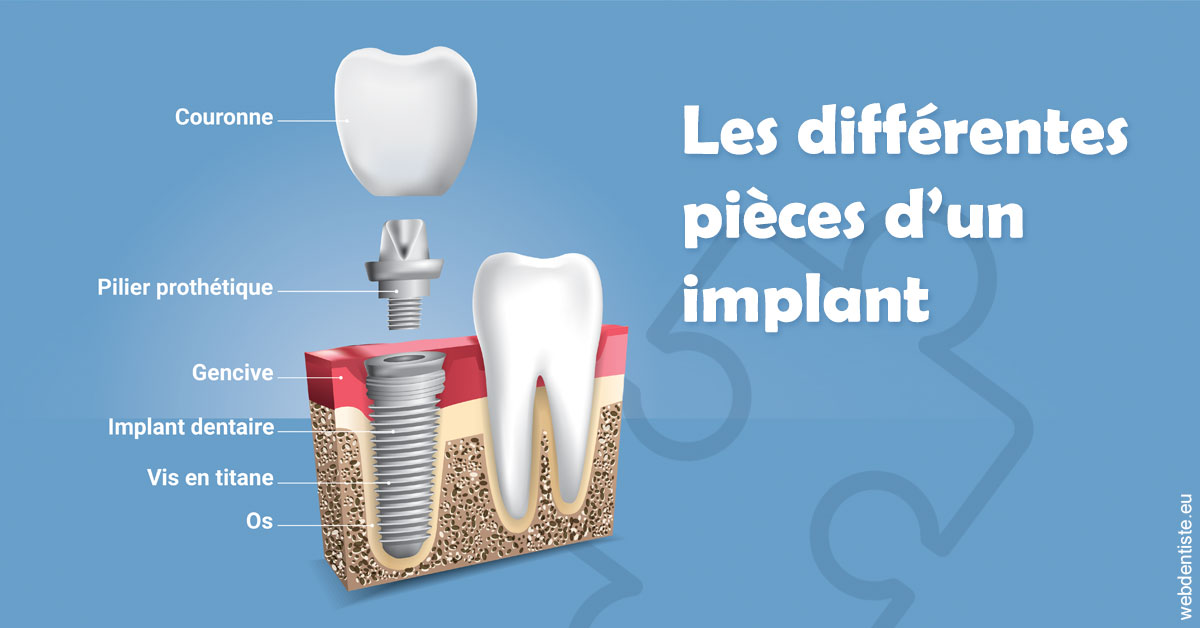 https://dr-andre-boquet-corinne-marie.chirurgiens-dentistes.fr/Les différentes pièces d’un implant 1